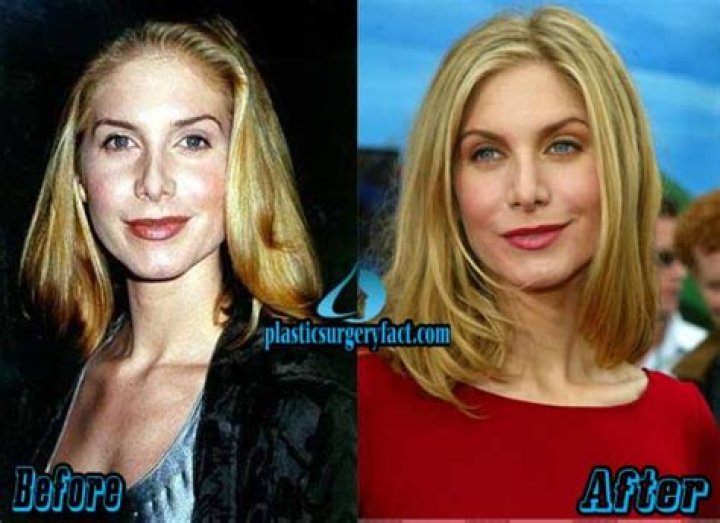 Elizabeth Mitchell Plastic Surgery Before and After